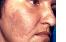 Melasma- Manchas do Rosto