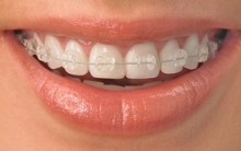 Cuidados Com Seu Aparelho Dental