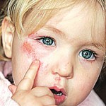 Celulite Infecciosa- Sintomas celulite infecciosa