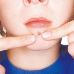 Cravos – Como Espremer Sem Marcar A Pele