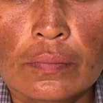 Manchas Na Pele Como E Onde Fazer O Tratamento 