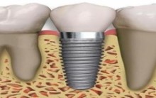 Implantes Dentários – Informações