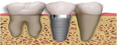 Implantes Dentários – Informações