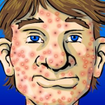 Acne Pode Causar Infecções E Câncer