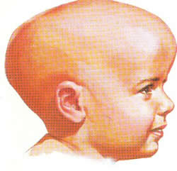 Hidrocefalia Infantil – Como se Tratar