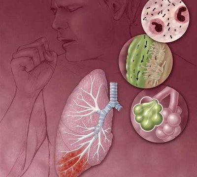Pneumonia – Causas e Sintomas