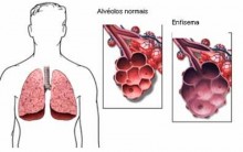 Bronquite Crônica – O que é, Tratamento