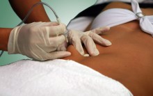 Carboxiterapia Tratamento Anti-estrias