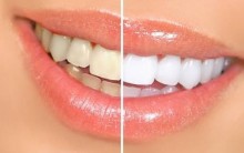 Clareamento Dental a Laser – Preço, Cuidados, Vantagens