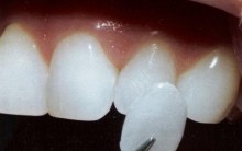 Novas Lentes de Contato Para os Dentes – Como Funciona, Onde Comprar, Vantagens