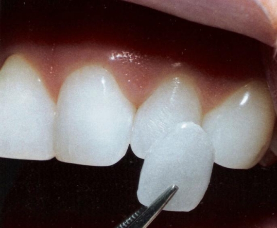 Novas Lentes de Contato Para os Dentes – Como Funciona, Onde Comprar, Vantagens