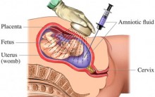 Liquido Amniótico na Gravidez –  O Que é, Para que Serve Perigos, Tratamento