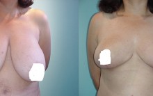 Mamoplastia Redutora – Para Que Serve, Fotos Antes e Depois,Vídeos, Qual o Preço