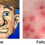 acne-foliculite