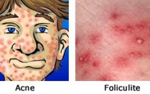 Foliculite – O Que é, Quais São as Causas, Seus Sintomas e Qual o Tratamento