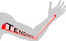 Tendinite – O Que é Quais os Sintomas, Qual Tipo de Tratamento, Vídeos