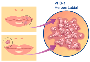 diagrama-herpes-labial