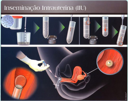 intra-uterina