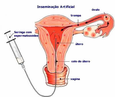 intra uterina