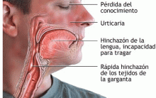 Choque Anafilático –  O que é, Quais os Sintomas e Tratamento