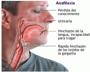 anafilaxia1