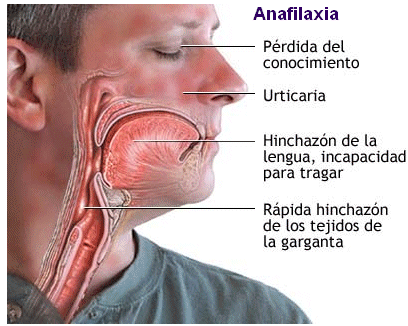Choque Anafilático –  O que é, Quais os Sintomas e Tratamento
