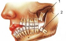 Quando Remover o Dente do Siso – Informações