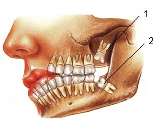 Quando Remover o Dente do Siso – Informações