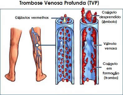 trombose