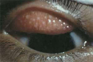 Olhos com Tracoma
