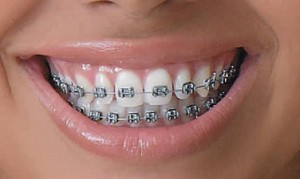 Ortodontia – Como é o Tratamento (1)