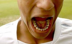 Ortodontia – Como é o Tratamento (2)