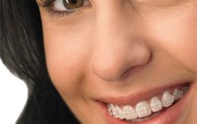 Ortodontia – Como é o Tratamento