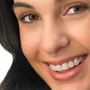 Ortodontia – Como é o Tratamento (3)