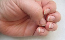 Micose de Unhas – Como Tratar, Sintomas e Prevenção