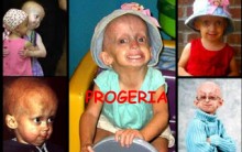 O Que É Doença Progeria – Sintomas, Tratamento e Causas