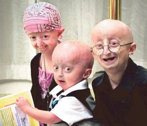 sinddrome de progeria
