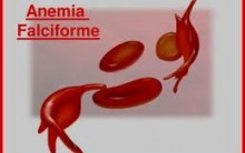 Anemia Falciforme – O Que é Quais os Sintomas e Tratamento