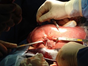 Cirurgia á Céu Aberto Para Salvar Bebês Ainda no Útero 