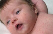 Brotoejas na Pele do Bebê – O Que Fazer Como Tratar