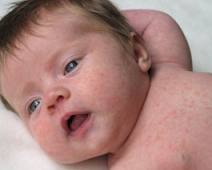 Brotoejas na Pele do Bebê – O Que Fazer Como Tratar