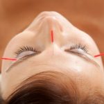 beneficios-da-acupuntura-estetica-555×400