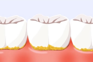 Tártaro nos Dentes – Receitas Completas Para Eliminar Este Problema