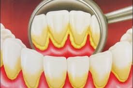 Receitas Completas Para Eliminar Este Problema do Tártaro nos Dentes